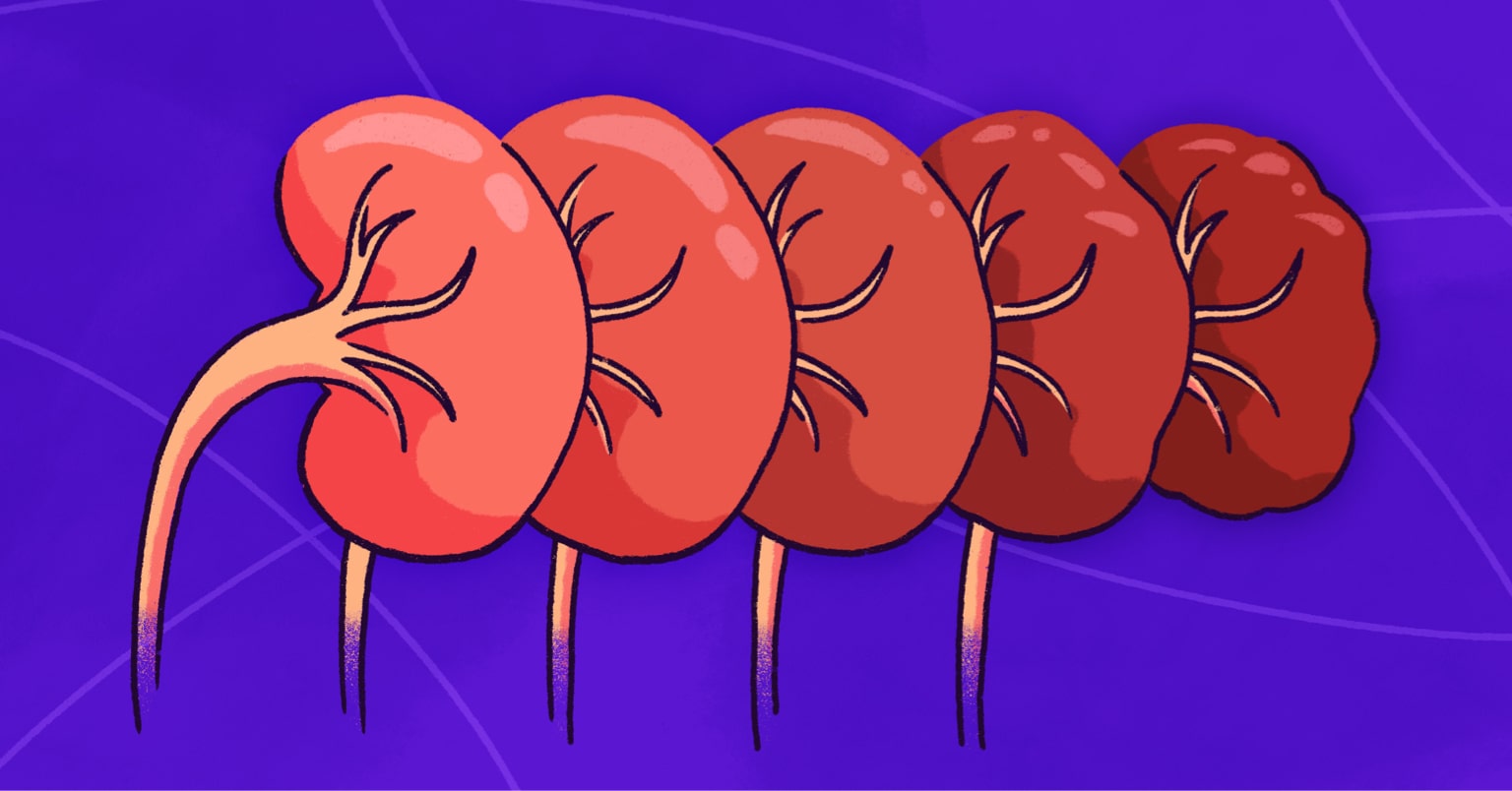 Exploring Chronic Kidney Disease: Familiarizing With Its Stages