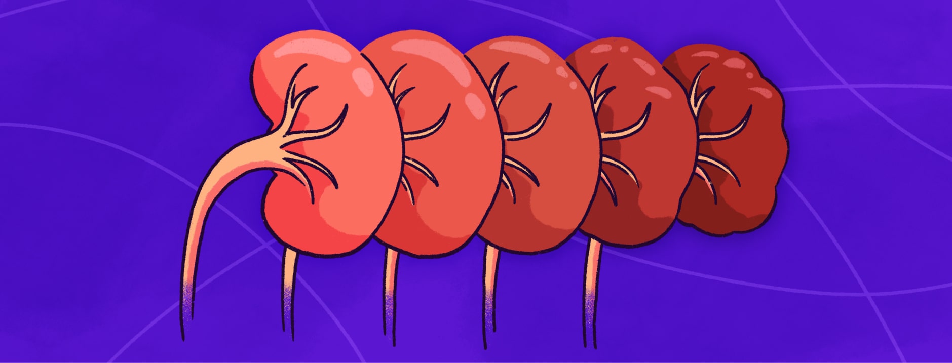 A series of 5 kidneys with progressive deterioration to depict the 5 stages of kidney disease.