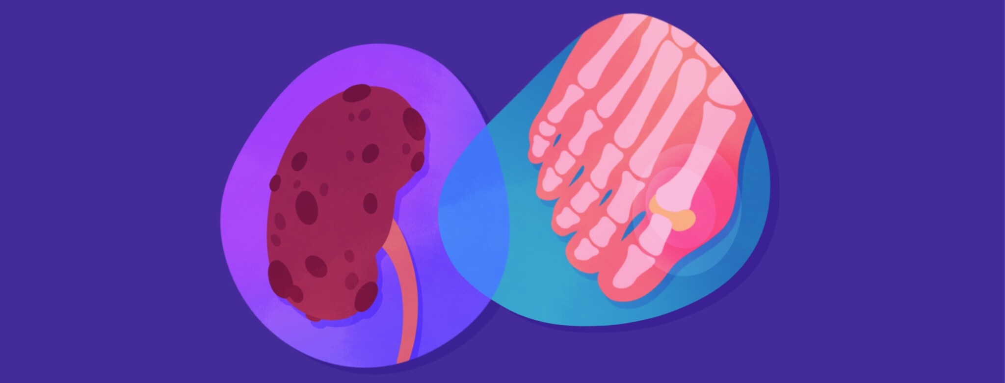 A diseased kidney overlapping with an x-ray of a foot presenting gout in the big toe
