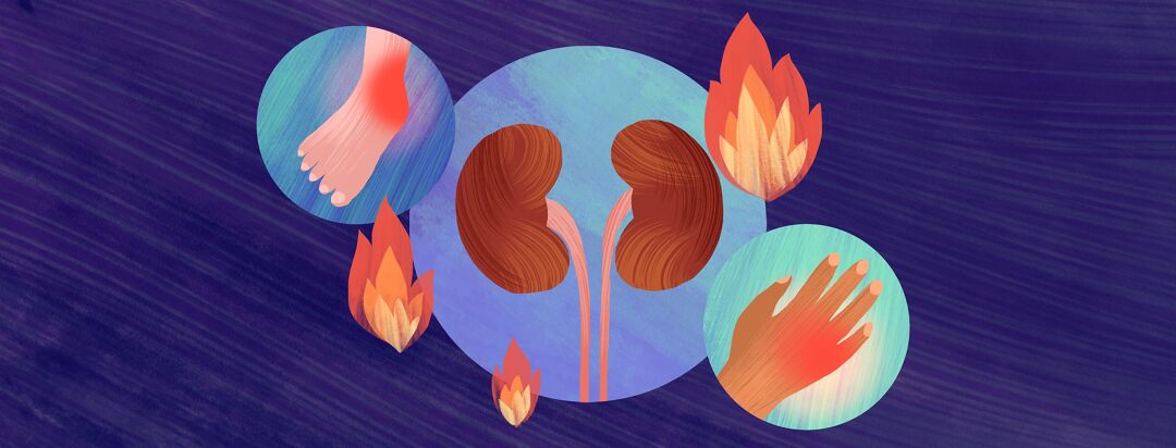 Beyond the Flare: The Reality of Living with Gout image